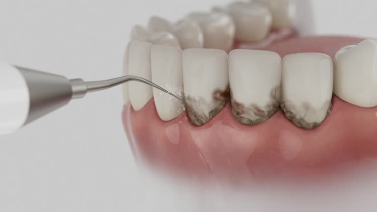 Trusted Wisdom Tooth Removal service in Mexia, TX - Dentist Open Now